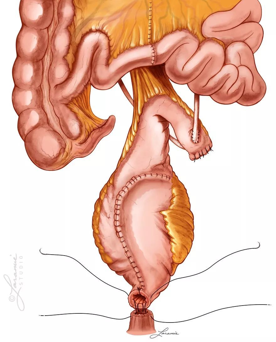 回肠通道术图片